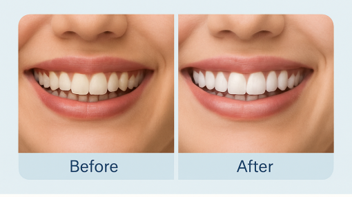 StoreTom Unisex Snap-On Veneers  | Natural Look | Instant Smile | BPA-Free| 1 pair (Uper and lower) - Image 3