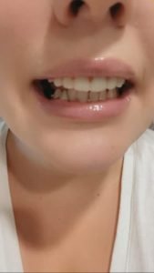 StoreTom Unisex Snap-On Veneers  | Natural Look | Instant Smile | BPA-Free| 1 pair (Uper and lower) photo review