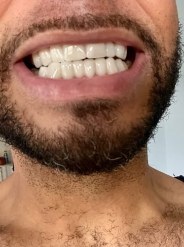 StoreTom Unisex Snap-On Veneers  | Natural Look | Instant Smile | BPA-Free| 1 pair (Uper and lower) photo review