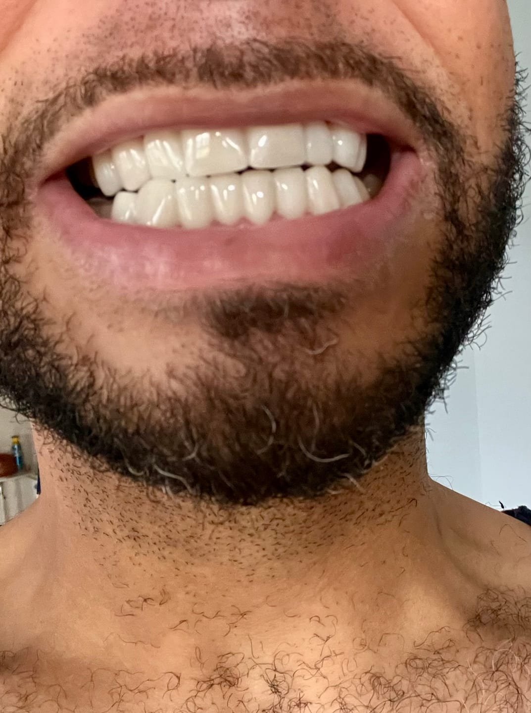 StoreTom Clip In Veneers | Snap On Veneers | 1 pair (Uper and lower) photo review