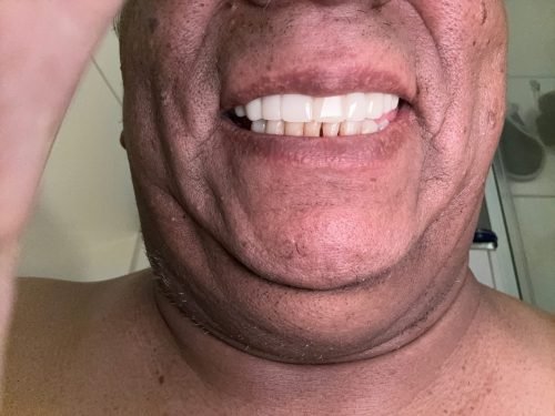 StoreTom Unisex Snap-On Veneers  | Natural Look | Instant Smile | BPA-Free| 1 pair (Uper and lower) photo review