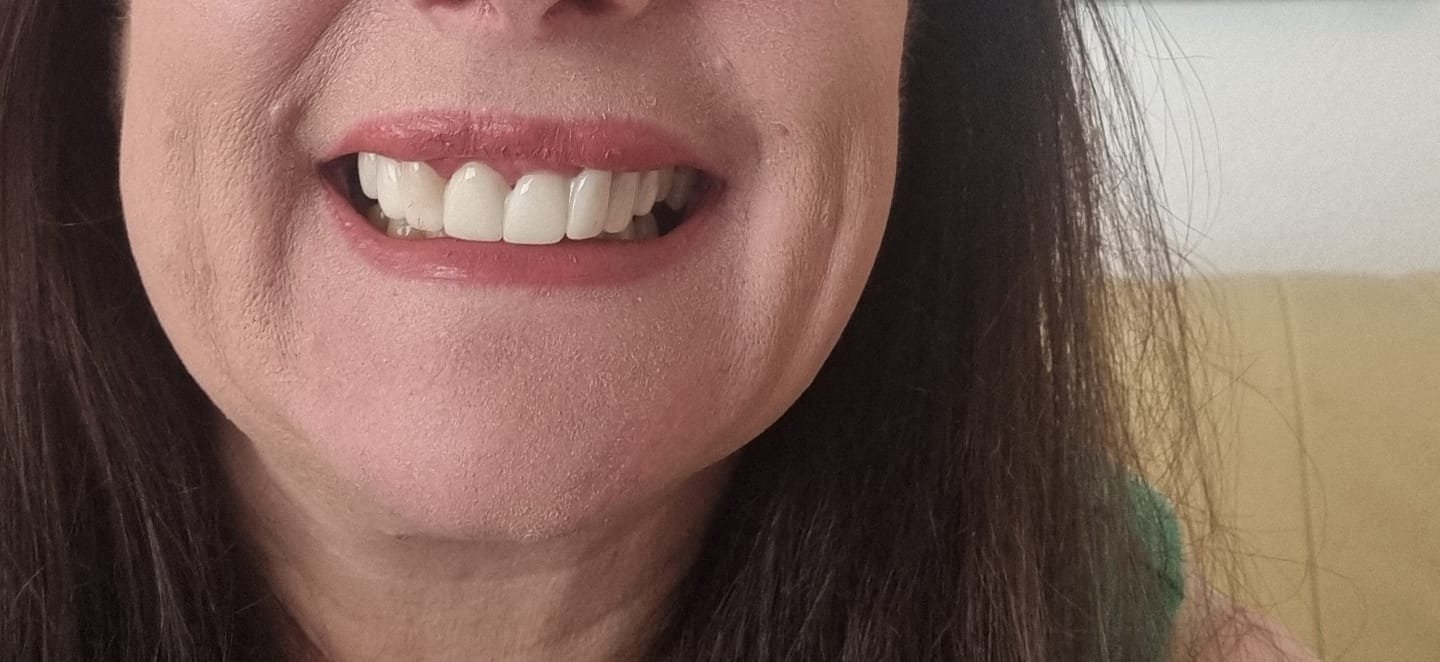 StoreTom Clip In Veneers | Snap On Veneers | 1 pair (Uper and lower) photo review